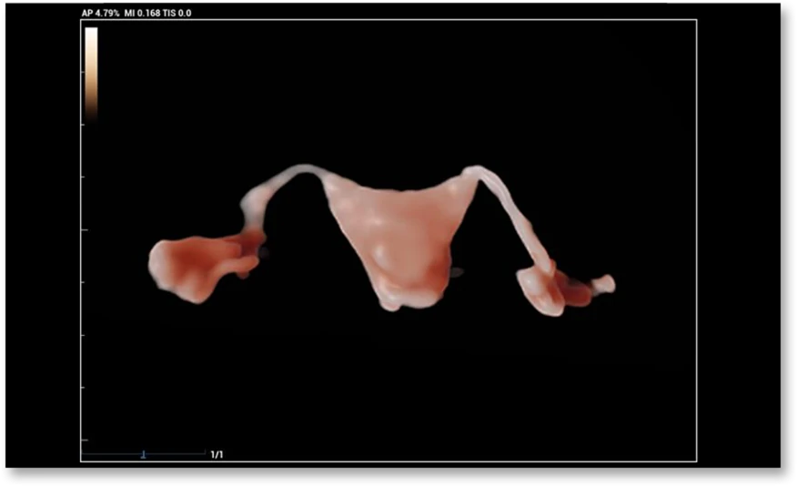 УЗИ аппарат Mindray Nuewa R9 — 3D/4D Гикозия (Гистеросальпингоконтрастная сонография)