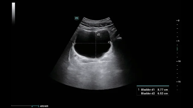УЗИ аппарат Mindray Consona N6 — Smart Bladder