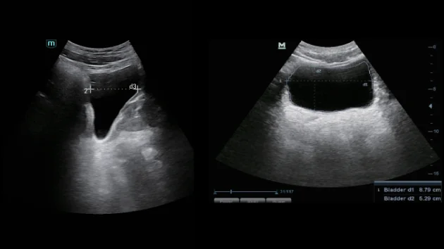 УЗИ аппарат Mindray Consona N9 — Smart Bladder