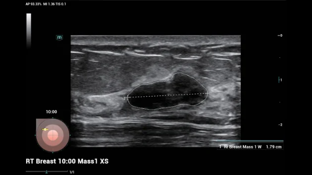 УЗИ аппарат Mindray Consona N8 — Smart Breast