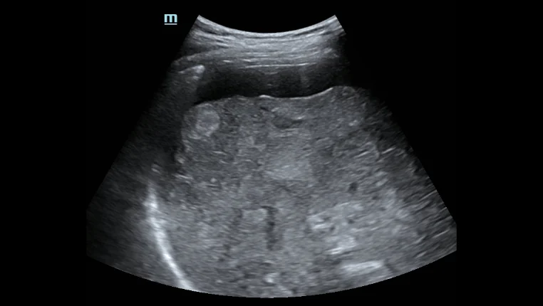 УЗИ аппарат Mindray Hepatus Series — Быстрое интеллектуальное сканирование Q-Scan