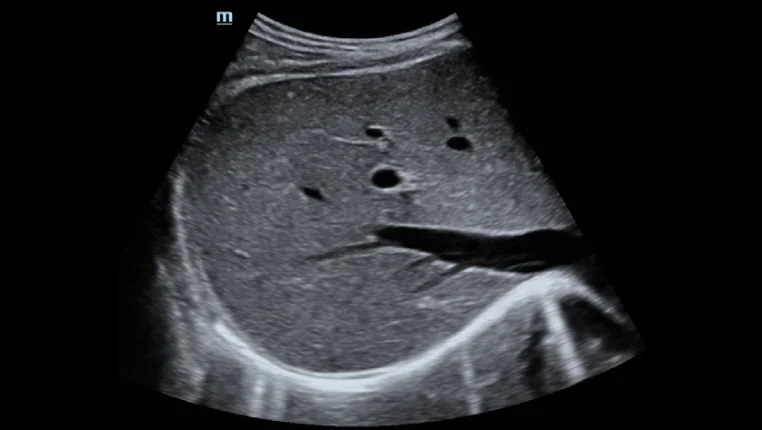 УЗИ аппарат Mindray Hepatus Series — Быстрое интеллектуальное сканирование Q-Scan