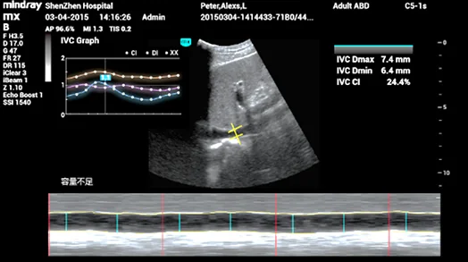 УЗИ аппарат Mindray ME-7 — Smart IVC