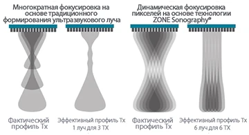 УЗИ аппарат Mindray MX7 — Динамическая фокусировка пикселей