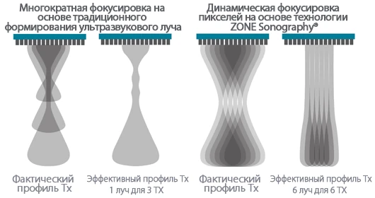 УЗИ аппарат Mindray Resona 7 — Динамическая фокусировка пикселей