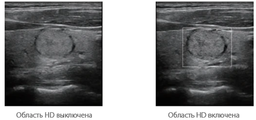 УЗИ аппарат Mindray Resona 7 — Динамическая фокусировка пикселей