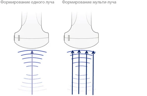 Mindray Z5 Формирование мульти-луча